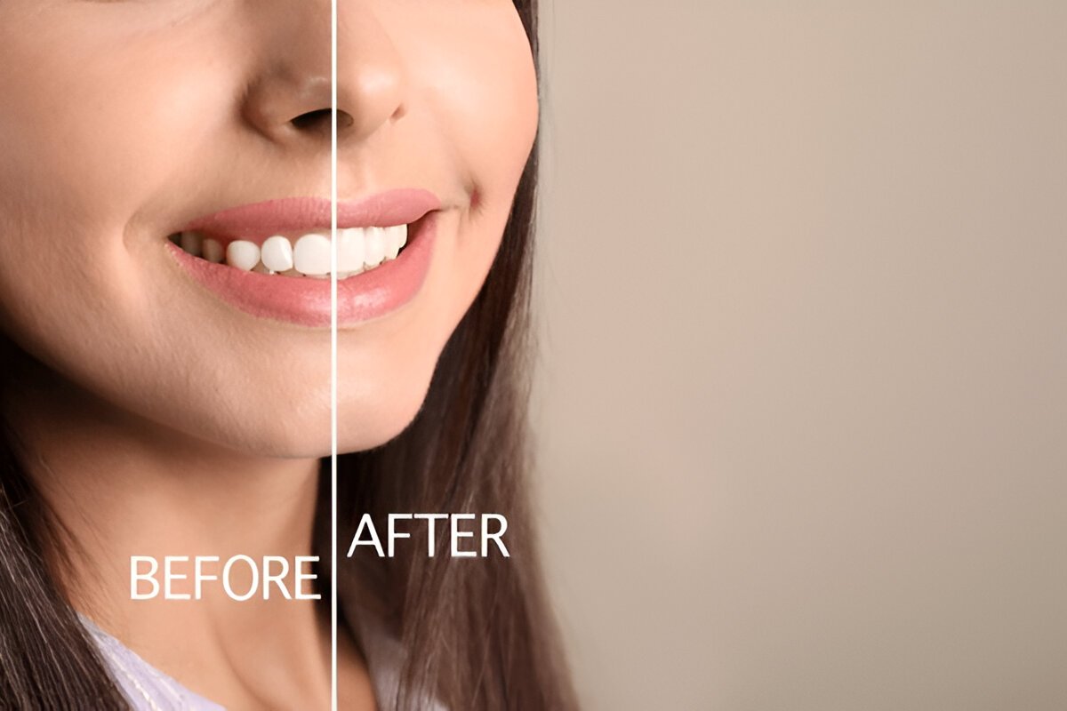 Gum Contouring Edmonton