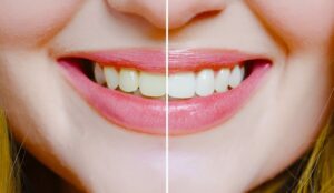 Teeth Cleaning Edmonton
